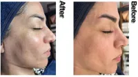 تخفیف ویژه 50٪ بر روی پکیج جامع پاکسازی و جوانسازی پوست (بانوان و آقایان)