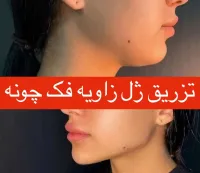 جشنواره بوتاکس کل صورت با تخفیف - فقط ۱,۲۰۰,۰۰۰ تومان!