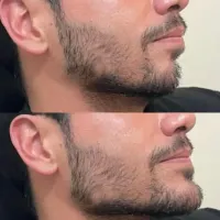 زاویه‌سازی صورت با ژل (گونه، چانه) - ۲,۵۰۰,۰۰۰ تومان!
