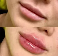برجسته‌سازی لب با ژل - ۶,۸۰۰,۰۰۰ تومان!