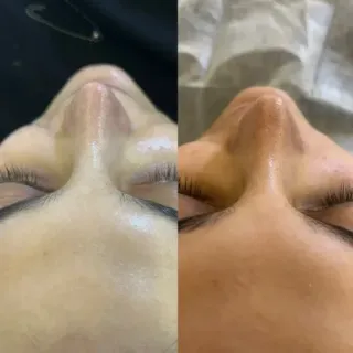 فیشیال،میکرونیدلینگ،جوانسازی عسل